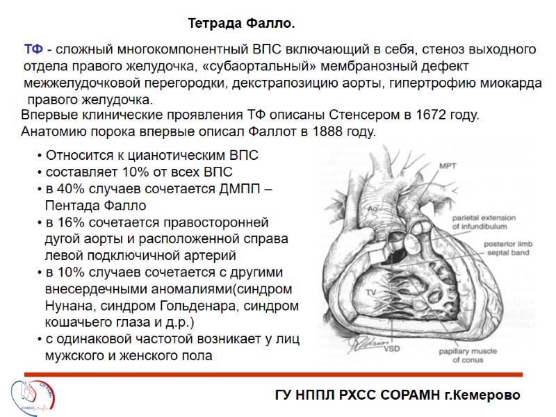 ГУ НППЛ РХСС СОРАМН г.Кемерово Тетрада Фалло. ТФ - сложный многокомпонентный ВПС включающий в